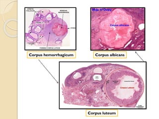 Corpus hemorrhagicum
Corpus luteum
Corpus albicans
 