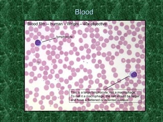 BBlloooodd 
Blood film -- human – Wright – 40x objective 
lymphocyte 
This is a large lymphocyte, not a macrophage. 
To call it a macrophage, the cell should be larger 
and have a flattened or indented nucleus. 
 