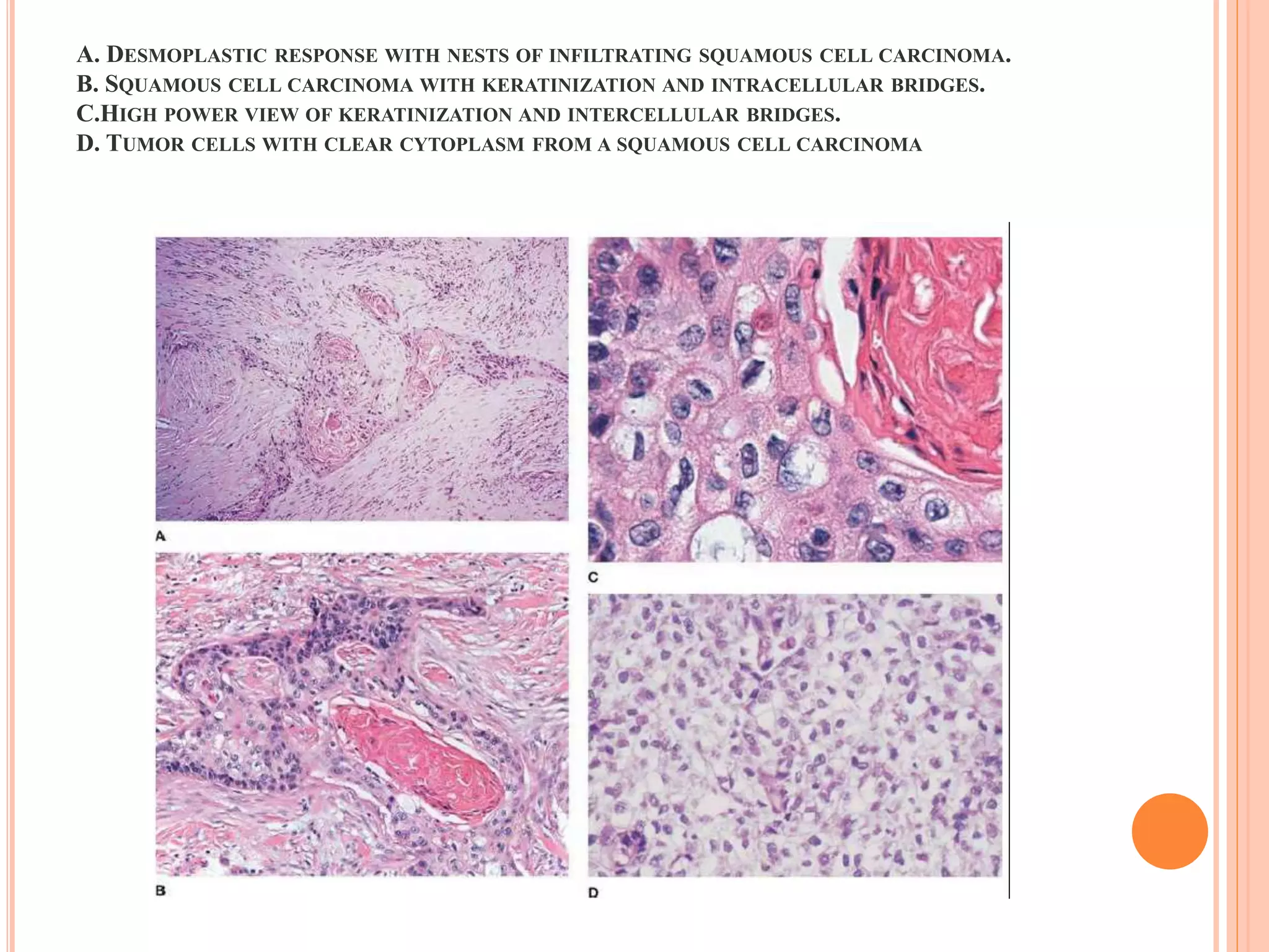 Histology and staging of lung cancer & metastatic | PPTX