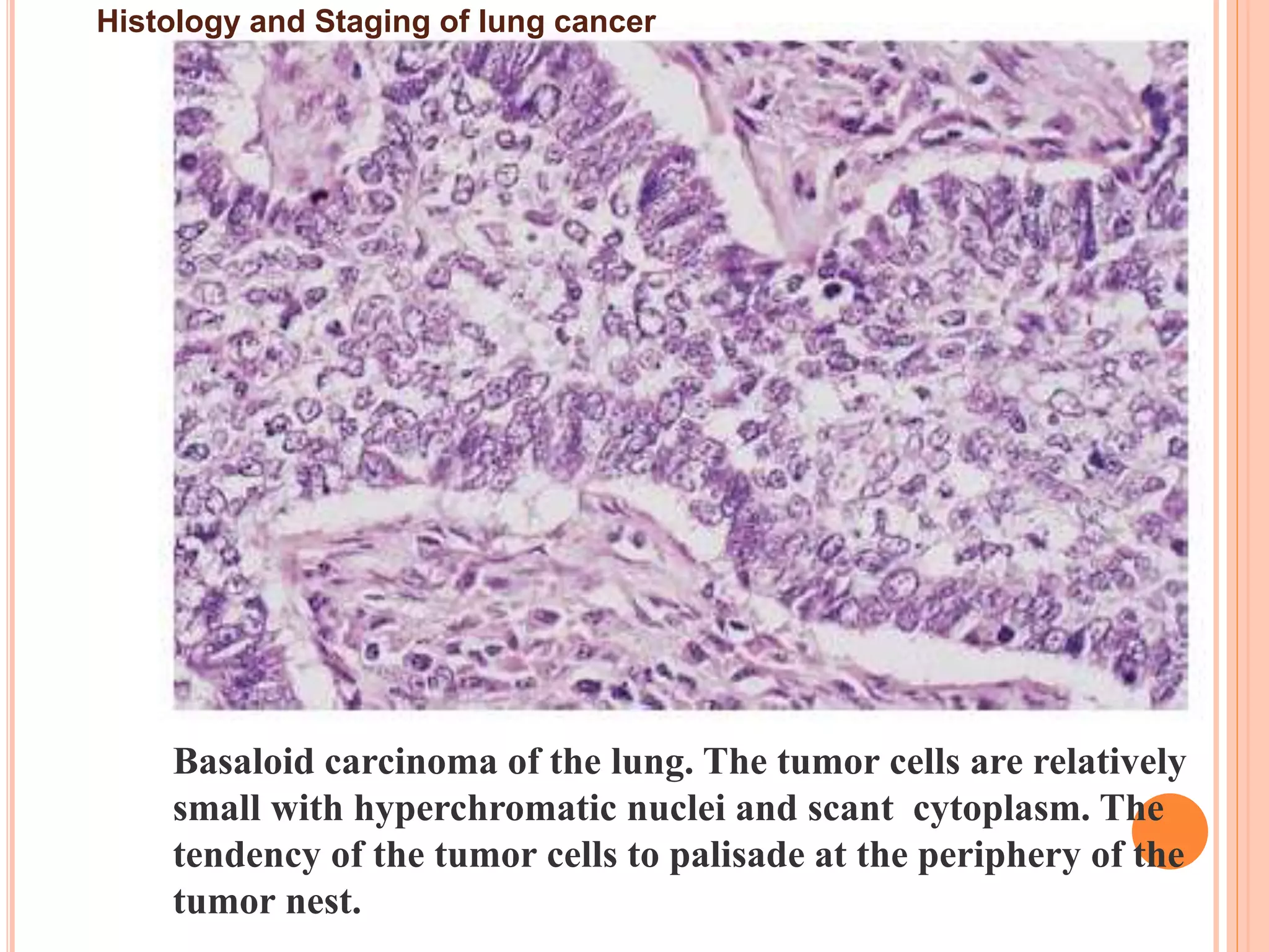 Histology and staging of lung cancer & metastatic | PPTX