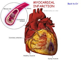 MYOCARDIAL   Back to Circula
INFARCTION
 