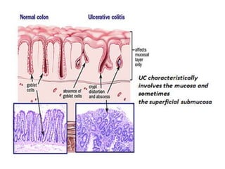 Histology of ibd | PPTX