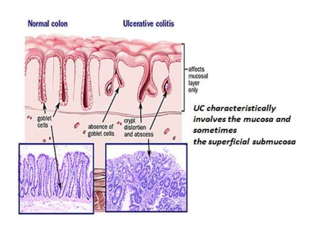 Histology of ibd | PPTX | Digestive Disorders | Diseases and Conditions