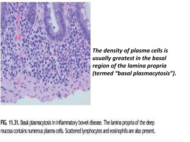Histology of ibd | PPTX | Digestive Disorders | Diseases and Conditions