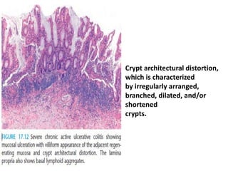 Histology of ibd | PPTX