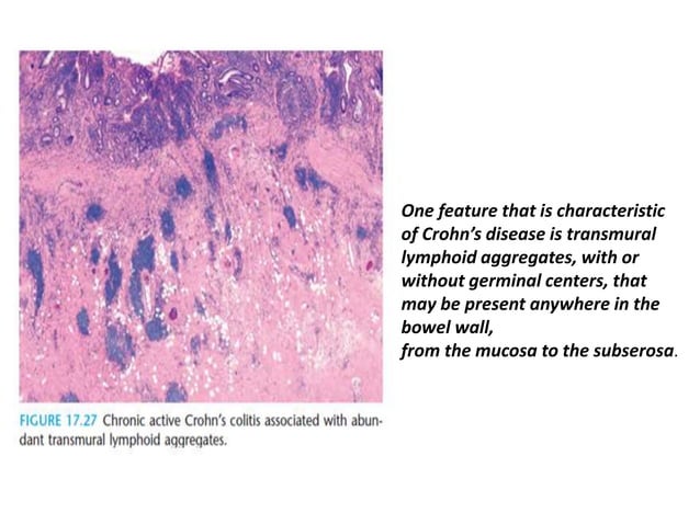 Histology of ibd | PPTX | Digestive Disorders | Diseases and Conditions