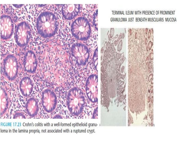 Histology of ibd | PPTX | Digestive Disorders | Diseases and Conditions