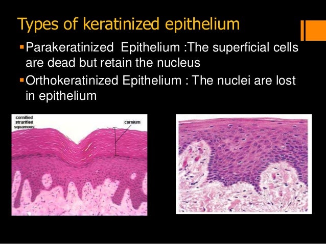 Definition of squamous cell carcinoma - NCI Dictionary of ...