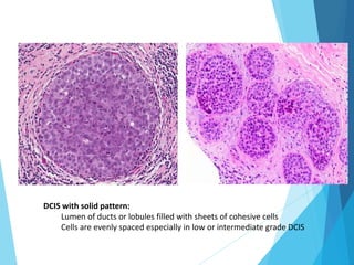 Histopathological Interpretation of Breast Cancer.pptx