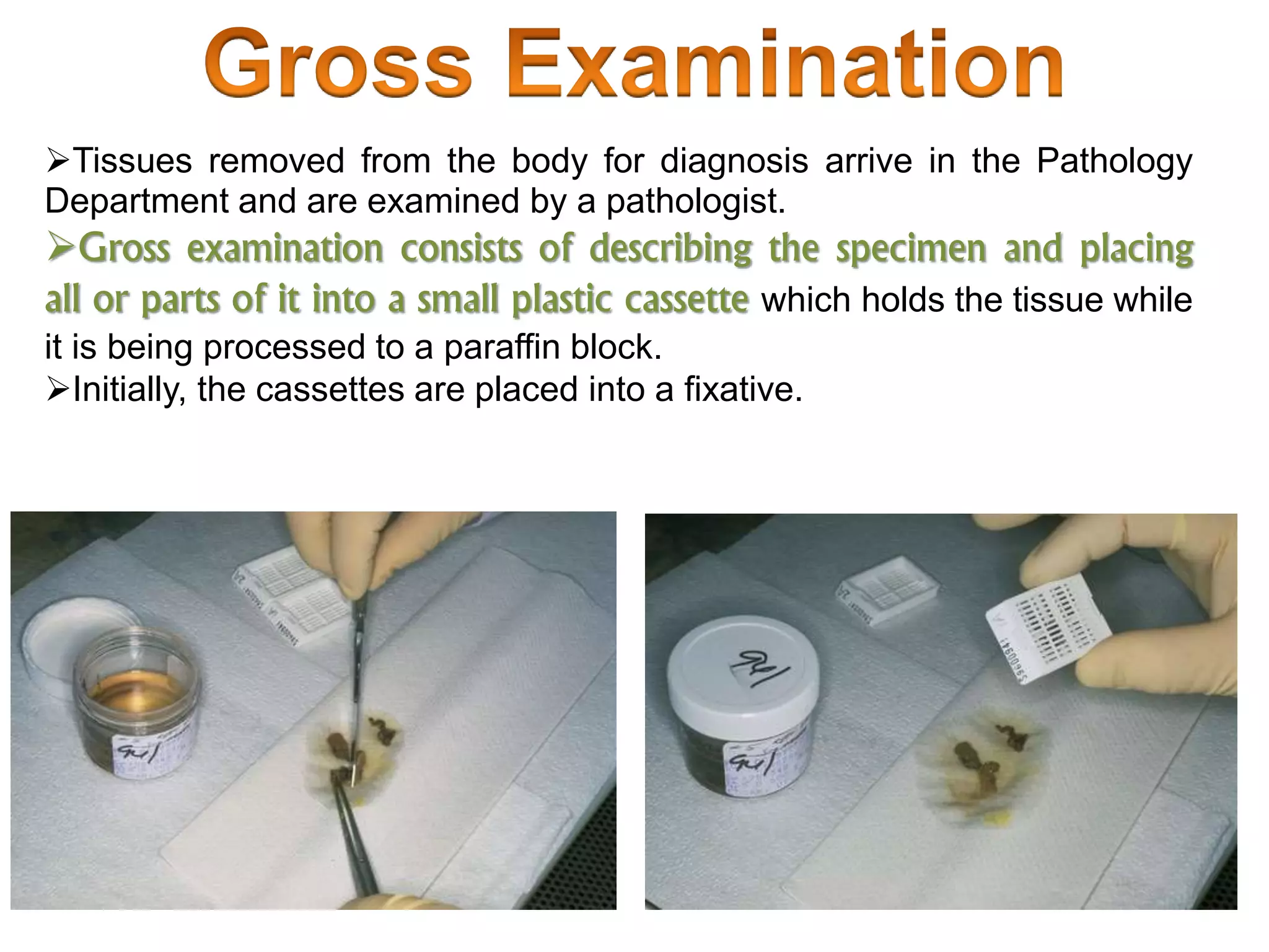 Tissues removed from the body for diagnosis arrive in the Pathology
Department and are examined by a pathologist.
Gross examination consists of describing the specimen and placing
all or parts of it into a small plastic cassette which holds the tissue while
it is being processed to a paraffin block.
Initially, the cassettes are placed into a fixative.
 