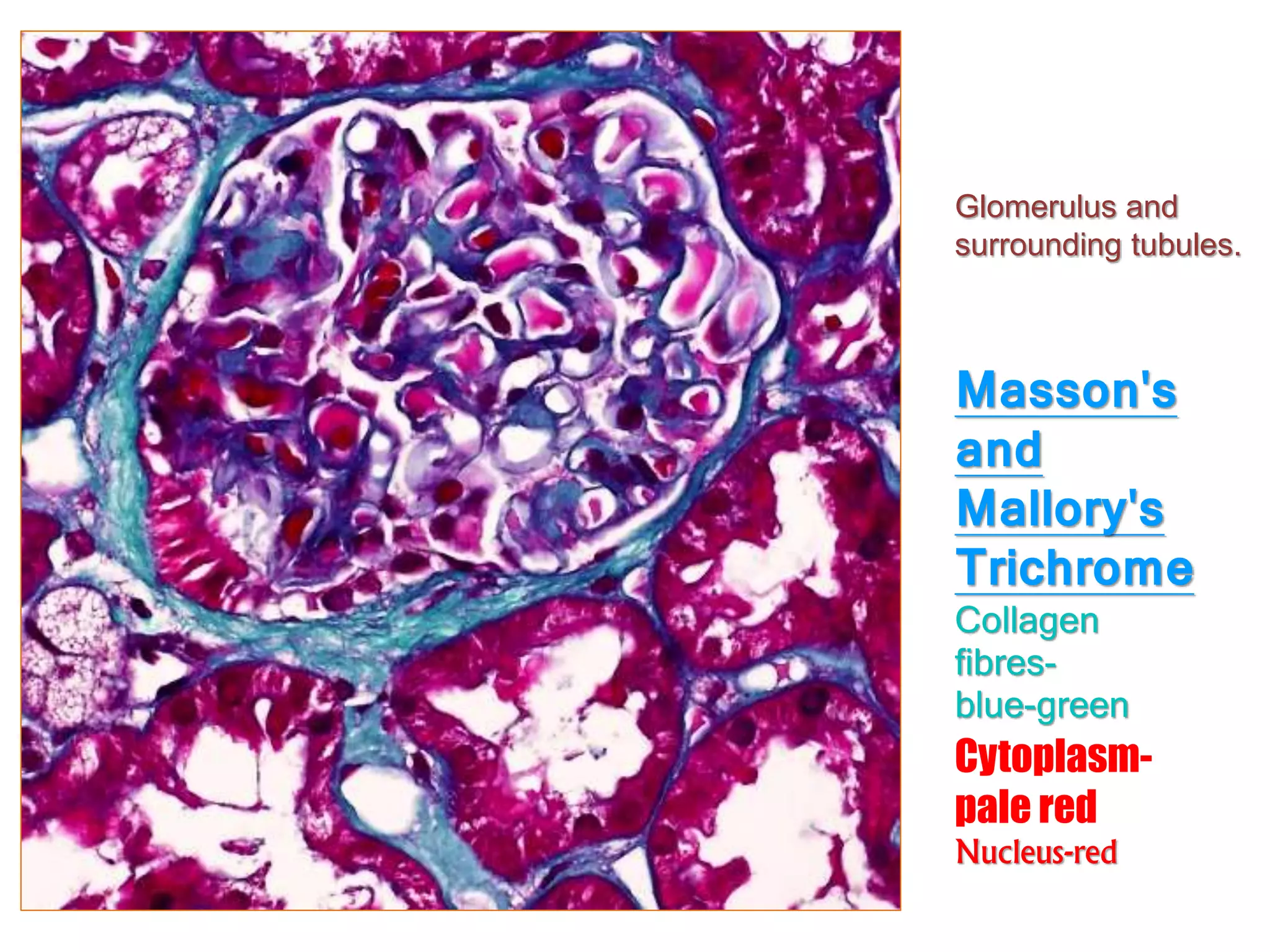 Masson's
and
Mallory's
Trichrome
Collagen
fibres-
blue-green
Cytoplasm-
pale red
Nucleus-red
Glomerulus and
surrounding tubules.
 