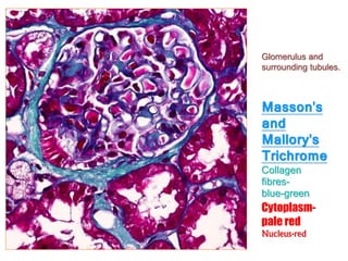 Masson's
and
Mallory's
Trichrome
Collagen
fibres-
blue-green
Cytoplasm-
pale red
Nucleus-red
Glomerulus and
surrounding tubules.
 