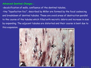 Histopathology_of_dental_Dental_caries_1_compressed.pdf