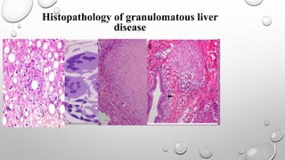 Histopathology of granulomatous liver
disease
 