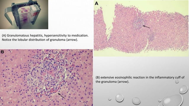 Histopathology of granulomatous liver disease | PDF | Digestive ...