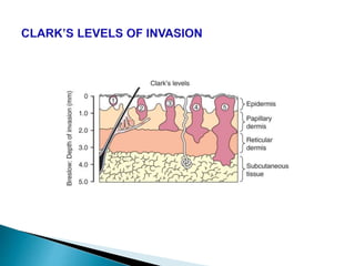 Histopathology of malignant melanoma | PPTX