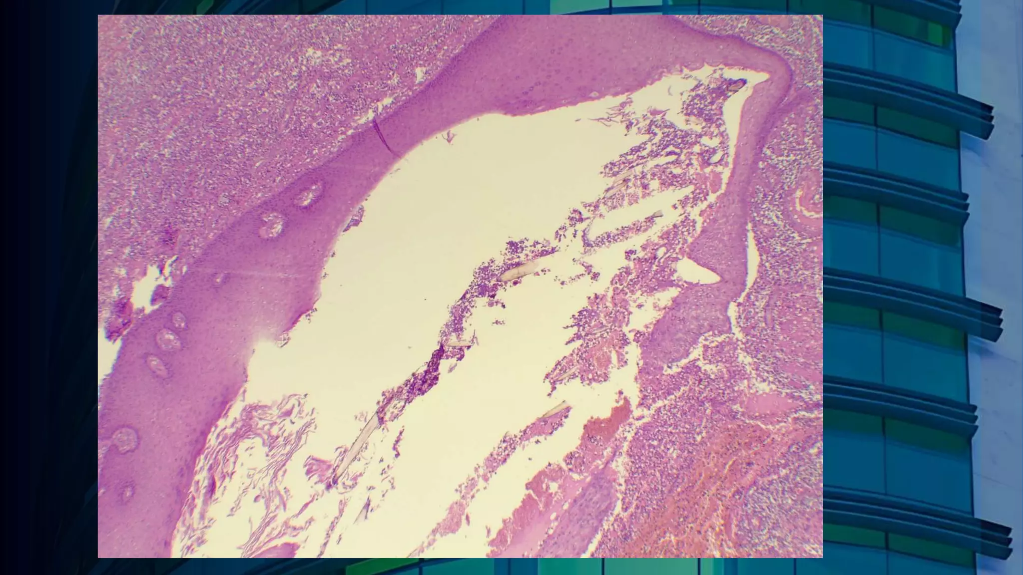 Pilonidal Sinus Racgp Histopathology of Pilonidal Sinus | PPTX