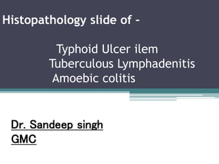 Histopathology slide of –
Typhoid Ulcer ilem
Tuberculous Lymphadenitis
Amoebic colitis
Dr. Sandeep singh
GMC
 