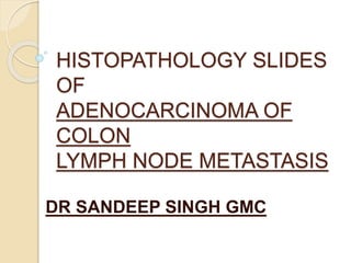 HISTOPATHOLOGY SLIDES
OF
ADENOCARCINOMA OF
COLON
LYMPH NODE METASTASIS
DR SANDEEP SINGH GMC
 