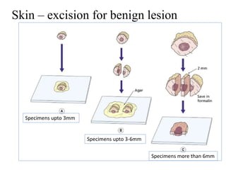 <4 mm
4-8 mm
Skin – excision for benign lesion
Specimens upto 3mm
Specimens upto 3-6mm
Specimens more than 6mm
 
