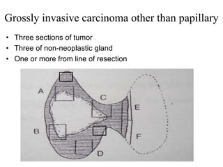 Grossly invasive carcinoma other than papillary
• Three sections of tumor
• Three of non-neoplastic gland
• One or more from line of resection
 