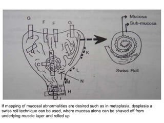 If mapping of mucosal abnormalities are desired such as in metaplasia, dysplasia a
swiss roll technique can be used, where mucosa alone can be shaved off from
underlying muscle layer and rolled up
 