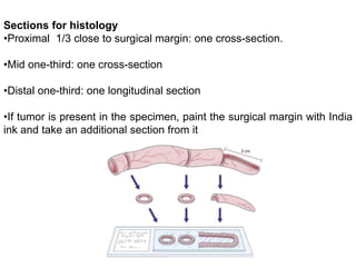 Sections for histology
•Proximal 1/3 close to surgical margin: one cross-section.
•Mid one-third: one cross-section
•Distal one-third: one longitudinal section
•If tumor is present in the specimen, paint the surgical margin with India
ink and take an additional section from it
 
