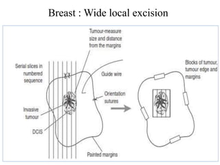 Breast : Wide local excision
 