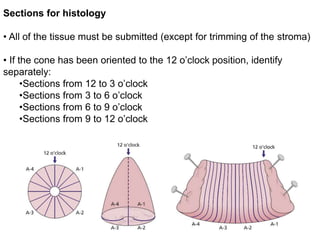 Sections for histology
• All of the tissue must be submitted (except for trimming of the stroma)
• If the cone has been oriented to the 12 o’clock position, identify
separately:
•Sections from 12 to 3 o’clock
•Sections from 3 to 6 o’clock
•Sections from 6 to 9 o’clock
•Sections from 9 to 12 o’clock
 