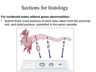 Sections for histology
For incidental tubes without gross abnormalities:
• Submit three cross-sections of each tube, taken from the proximal,
mid, and distal portions, submitted in the same cassette
 