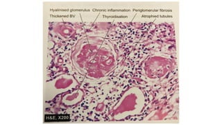 Caseation Hitopath histopath slides.pptx mbbs Second year . | PPTX
