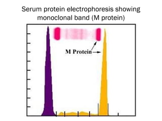 Normal serum protein electrophoresisSerum protein electrophoresis showing
monoclonal band (M protein)
 