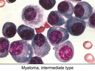 Myeloma, intermediate type
 