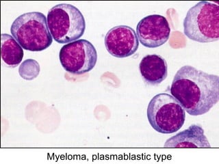 Myeloma, plasmablastic type
 