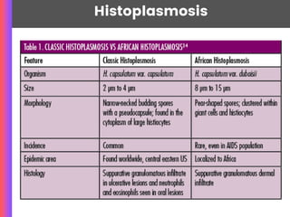 Histoplasmosis
 