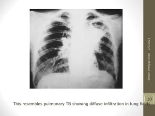 This resembles pulmonary TB showing diffuse infiltration in lung fields
10
2/3/2021
Shabir
Imteyaz
Khan
 