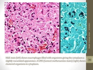 H&Estain(left)showsmacrophagesfilledwithorganismsgivingthecytoplasma
slightlyvacuolatedappearance.AGMS(Gomorimethenaminestain)(right)shows
clusteredorganismsincytoplasm.
30
2/3/2021
Shabir
Imteyaz
Khan
 