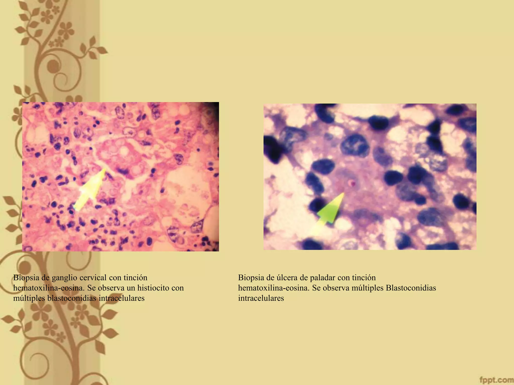 Biopsia de ganglio cervical con tinción
hematoxilina-eosina. Se observa un histiocito con
múltiples blastoconidias intracelulares

Biopsia de úlcera de paladar con tinción
hematoxilina-eosina. Se observa múltiples Blastoconidias
intracelulares

 