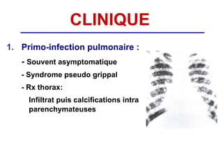 CLINIQUE
1. Primo-infection pulmonaire :
   - Souvent asymptomatique
   - Syndrome pseudo grippal
   - Rx thorax:
     Infiltrat puis calcifications intra
     parenchymateuses
 