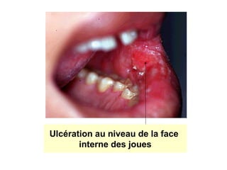 Ulcération au niveau de la face
       interne des joues
 