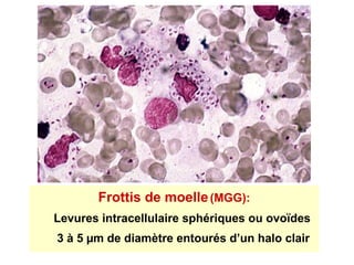 Frottis de moelle (MGG):
Levures intracellulaire sphériques ou ovoïdes
3 à 5 µm de diamètre entourés d’un halo clair
 