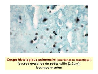 Coupe histologique pulmonaire (imprégnation argentique):
      levures ovalaires de petite taille (2-3µm),
                  bourgeonnantes
 