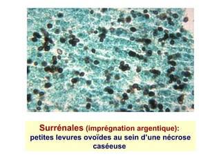 Surrénales (imprégnation argentique):
petites levures ovoïdes au sein d’une nécrose
                  caséeuse
 