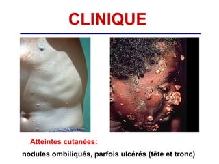 CLINIQUE




  Atteintes cutanées:
nodules ombiliqués, parfois ulcérés (tête et tronc)
 