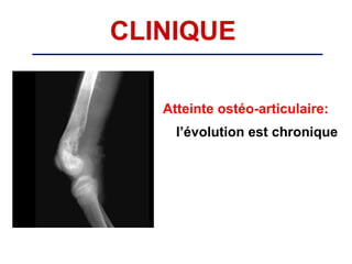 CLINIQUE

   Atteinte ostéo-articulaire:
     l’évolution est chronique
 