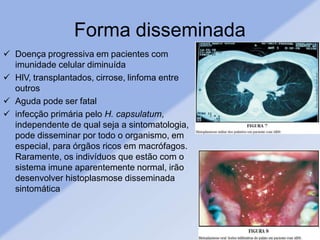 Forma disseminada
 Doença progressiva em pacientes com
imunidade celular diminuída
 HIV, transplantados, cirrose, linfoma entre
outros
 Aguda pode ser fatal
 infecção primária pelo H. capsulatum,
independente de qual seja a sintomatologia,
pode disseminar por todo o organismo, em
especial, para órgãos ricos em macrófagos.
Raramente, os indivíduos que estão com o
sistema imune aparentemente normal, irão
desenvolver histoplasmose disseminada
sintomática
 