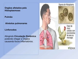 Orgãos afetados pela
Histoplasmose:
Pulmão
Alvéolos pulmonares
Linfonodos
Atingindo Circulação Sistêmica
podendo chegar a Órgãos
causando focos inflamatórios.
 