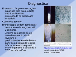 Diagnóstico
Encontrar o fungo em secreções
orgânicas pelo exame direto
não é fácil,mesmo
empregando-se colorações
especiais.
Cultura de Escarro
Broncoscopia podem demonstrar
crescimento do fungo em até
2 semanas.
A forma patogênica de um
único brotamento, do tipo
levedura é
predominantemente isolado a
partir de amostras de tecidos
infectados e ocorre quando o
micro-organismo é cultivado a
37ºC em laboratório
http://www.scielo.br/scielo.php?scri
pt=sci_arttext&pid=S1517-
83822006000100001
 