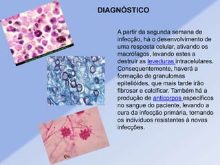 A partir da segunda semana de
infecção, há o desenvolvimento de
uma resposta celular, ativando os
macrófagos, levando estes a
destruir as leveduras intracelulares.
Consequentemente, haverá a
formação de granulomas
epitelióides, que mais tarde irão
fibrosar e calcificar. Também há a
produção de anticorpos específicos
no sangue do paciente, levando a
cura da infecção primária, tornando
os indivíduos resistentes à novas
infecções.
DIAGNÓSTICO
 
