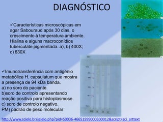DIAGNÓSTICO
Características microscópicas em
agar Sabouraud após 30 dias, o
crescimento à temperatura ambiente.
Hialina e alguns macroconídios
tuberculate pigmentada. a), b) 400X;
c) 630X
Imunotransferência com antigénio
metabólica H. capsulatum que mostra
a presença de 94 kDa banda.
a) no soro do paciente.
b)soro de controlo apresentando
reação positiva para histoplasmose.
c) soro de controlo negativo.
PM) padrão de peso molecular
http://www.scielo.br/scielo.php?pid=S0036-46651999000300012&script=sci_arttext
 